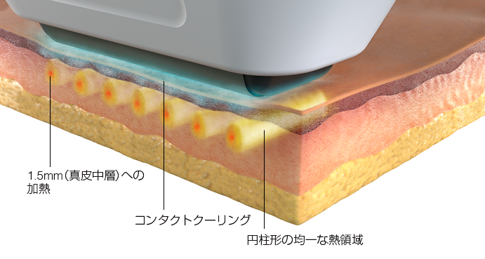 ソフウェーブの照射イメージ