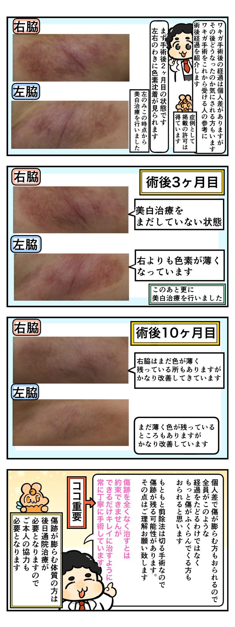 ワキガ手術後の経過説明