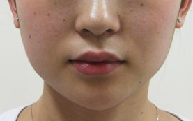 輪郭の治療 広島の美容外科 美容皮膚科 美容整形ならさくら美容クリニック