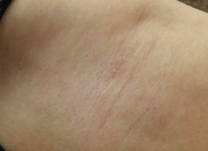 わきが手術を受けて10年経ったら傷跡はどうなる 広島の美容外科 美容皮膚科 美容整形ならさくら美容クリニック