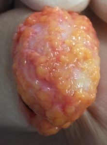 小学生のワキガ手術でした 広島の美容外科 美容皮膚科 美容整形ならさくら美容クリニック 小学生のワキガ手術でした 広島の美容外科 美容皮膚科 美容整形ならさくら美容クリニック